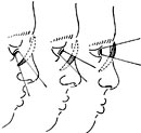 Lenti trifocale che dà la possibilità di vedere nitido a distanze differenti