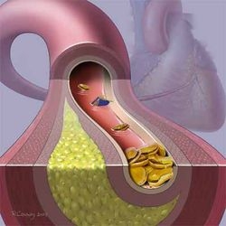 ARTERIOSCLEROSI - Denominazione generica designante una malattia involutiva del sistema arterioso caratterizzata da un complesso di lesioni di tipo, e