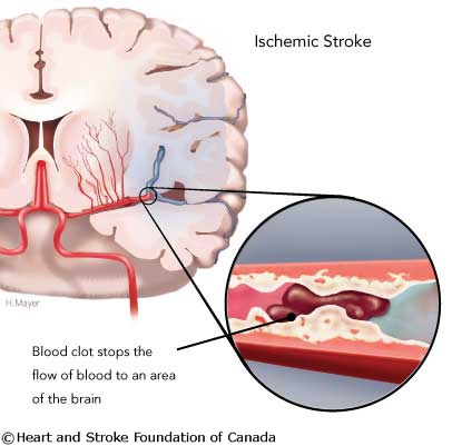 ISCHEMIA