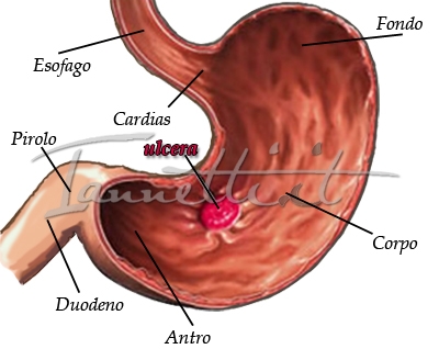 CANCRO DELLO STOMACO